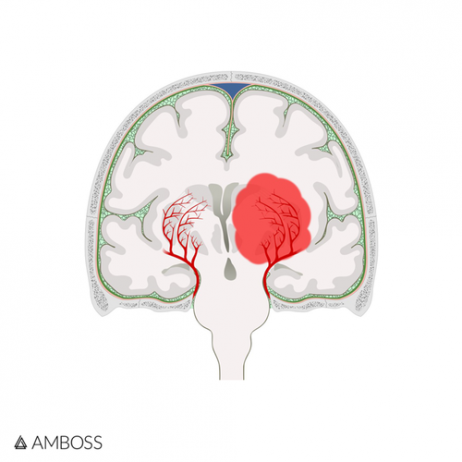 Learning about strokes for NBME Neurology Shelf Exam